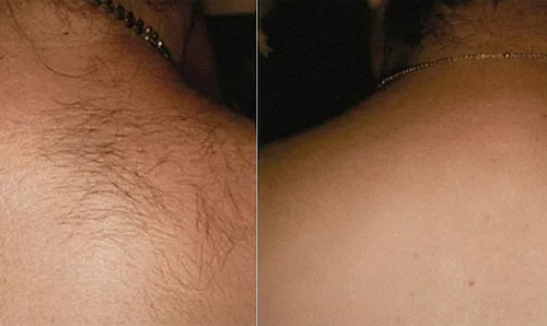 laser hair removal before after mississauga oakville